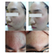 26W 60Hz Plasma Pen Acne Scars For Eyelids Face Liting Anti Wrinkle Aging